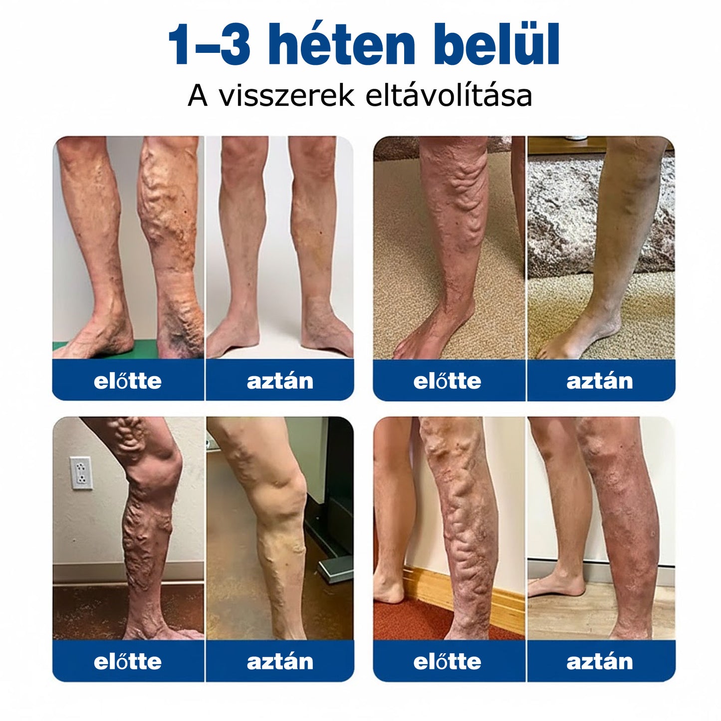 🌷🌷GFOUK® VeinEase mikrotűs ápoló tapasz⚡Azonnali enyhülés, hosszú távú eredmények
