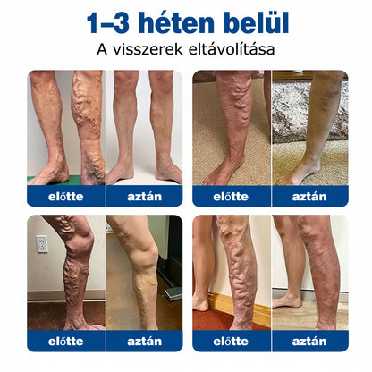 🌷🌷GFOUK® VeinEase mikrotűs ápoló tapasz⚡Azonnali enyhülés, hosszú távú eredmények
