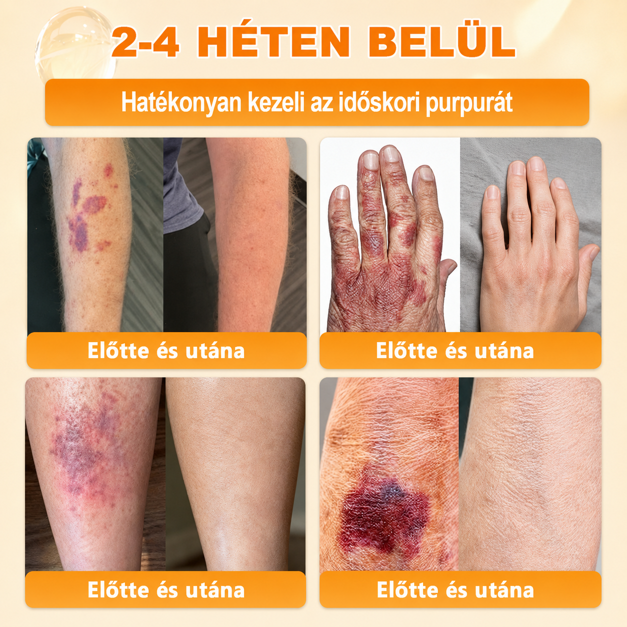 🥇Most 50% kedvezménnyel elérhető! ✨✨ DR.Fachmer® 🐝 Méhméreges Bőrmegújító Krém – Ráncok, Hegek, Pigmentfoltok, Striák, Akné, Ekcéma, Pikkelysömör Ellen (Copy) (Copy)