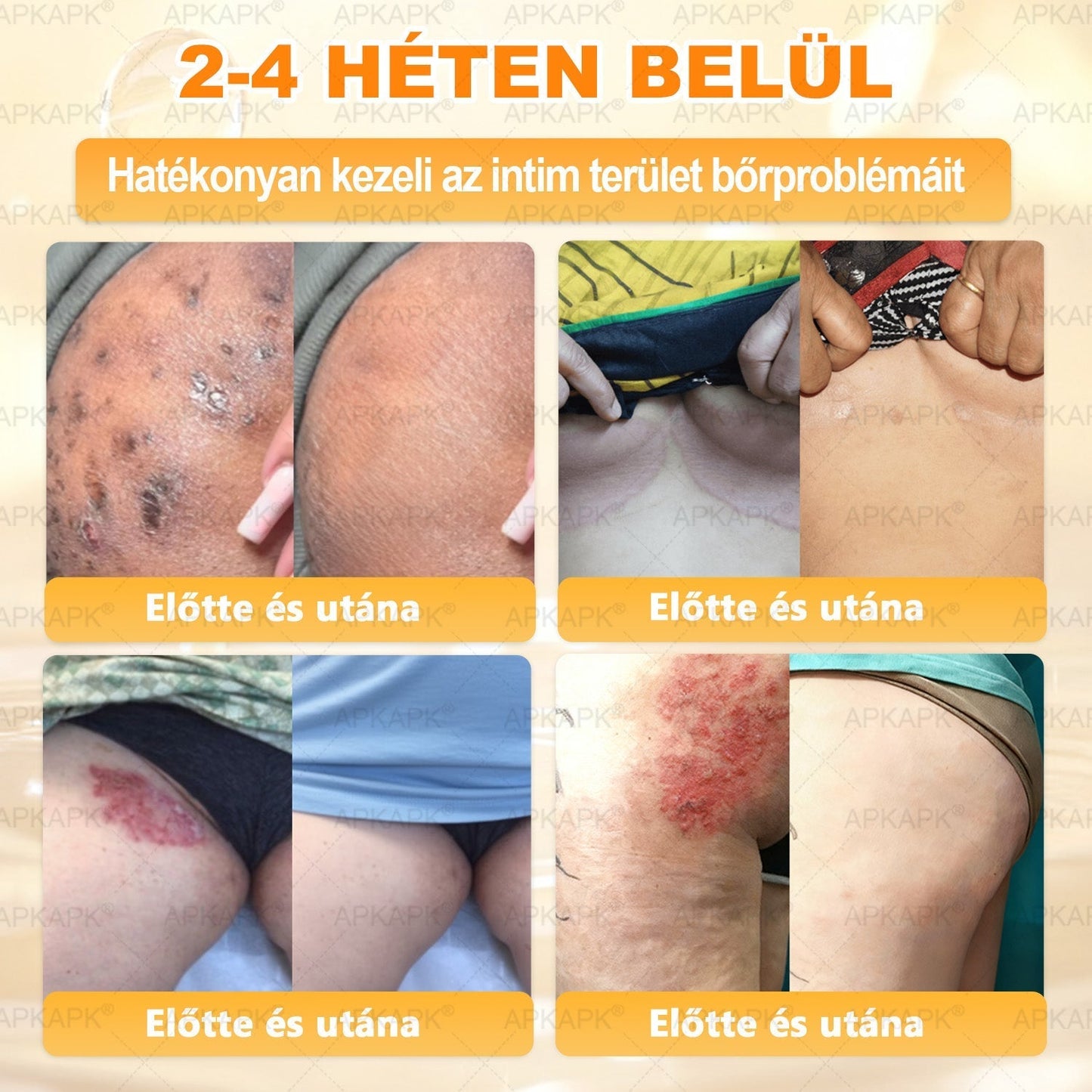 ✨✨ 🔥 Most 50% kedvezménnyel elérhető! ✨✨ DR.Fachmer® 🐝 Méhméreges Bőrmegújító Krém – Ráncok, Hegek, Pigmentfoltok, Striák, Akné, Ekcéma, Pikkelysömör Ellen