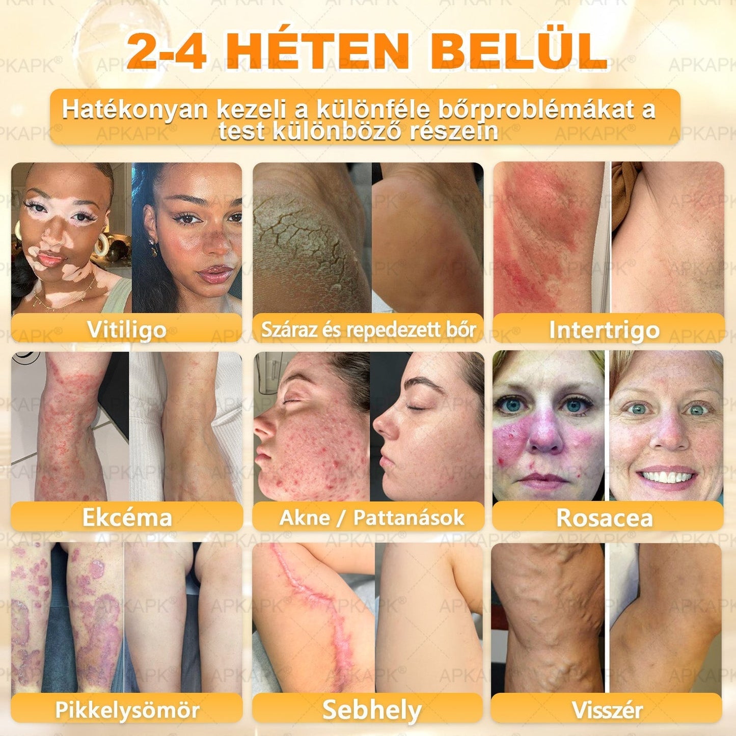 ✨✨ 🔥 Most 50% kedvezménnyel elérhető! ✨✨ DR.Fachmer® 🐝 Méhméreges Bőrmegújító Krém – Ráncok, Hegek, Pigmentfoltok, Striák, Akné, Ekcéma, Pikkelysömör Ellen