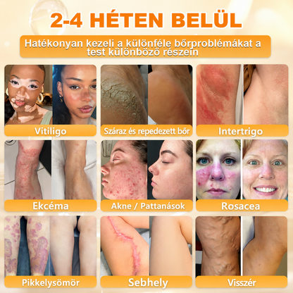 🥇Most 50% kedvezménnyel elérhető! ✨✨ DR.Fachmer® 🐝 Méhméreges Bőrmegújító Krém – Ráncok, Hegek, Pigmentfoltok, Striák, Akné, Ekcéma, Pikkelysömör Ellen (Copy) (Copy)