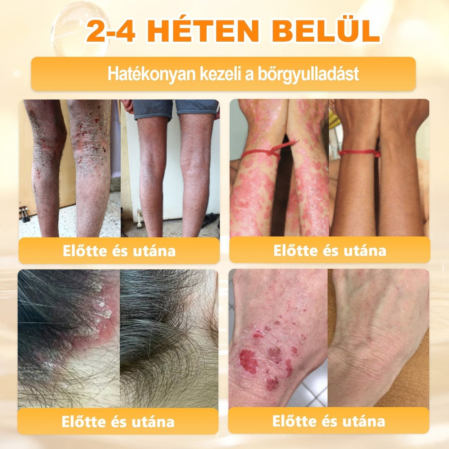 ✨✨ 🔥 Most 50% kedvezménnyel elérhető! ✨✨ DR.Fachmer® 🐝 Méhméreges Bőrmegújító Krém – Ráncok, Hegek, Pigmentfoltok, Striák, Akné, Ekcéma, Pikkelysömör Ellen