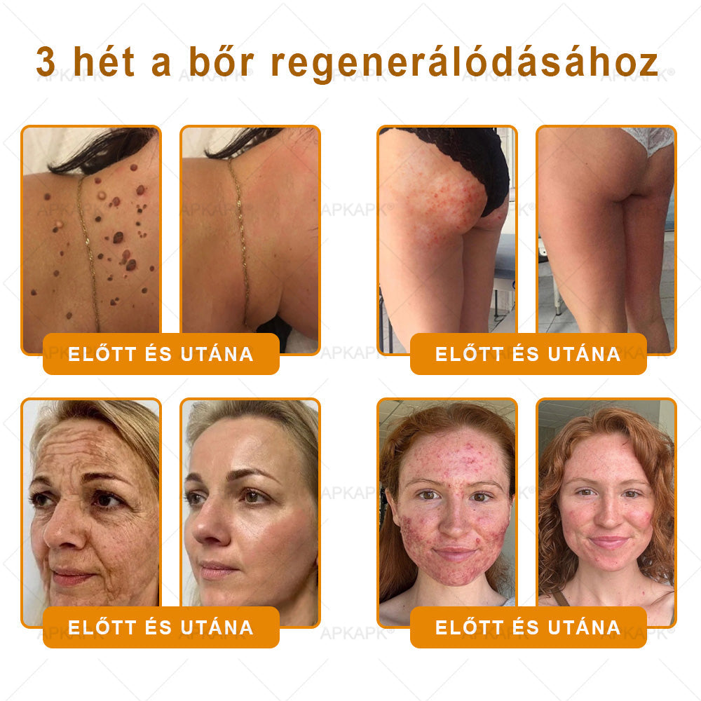✨✨ 🔥 Most 50% kedvezménnyel elérhető! ✨✨ DR.Fachmer® 🐝 Méhméreges Bőrmegújító Krém – Ráncok, Hegek, Pigmentfoltok, Striák, Akné, Ekcéma, Pikkelysömör Ellen