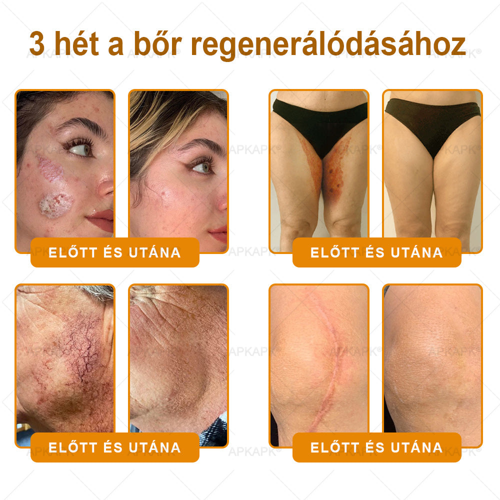 ✨✨ 🔥 Most 50% kedvezménnyel elérhető! ✨✨ DR.Fachmer® 🐝 Méhméreges Bőrmegújító Krém – Ráncok, Hegek, Pigmentfoltok, Striák, Akné, Ekcéma, Pikkelysömör Ellen