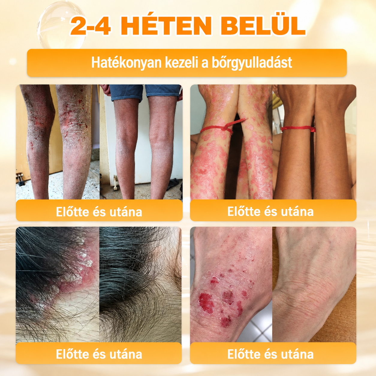 🥇Most 50% kedvezménnyel elérhető! ✨✨ DR.Fachmer® 🐝 Méhméreges Bőrmegújító Krém – Ráncok, Hegek, Pigmentfoltok, Striák, Akné, Ekcéma, Pikkelysömör Ellen (Copy) (Copy)