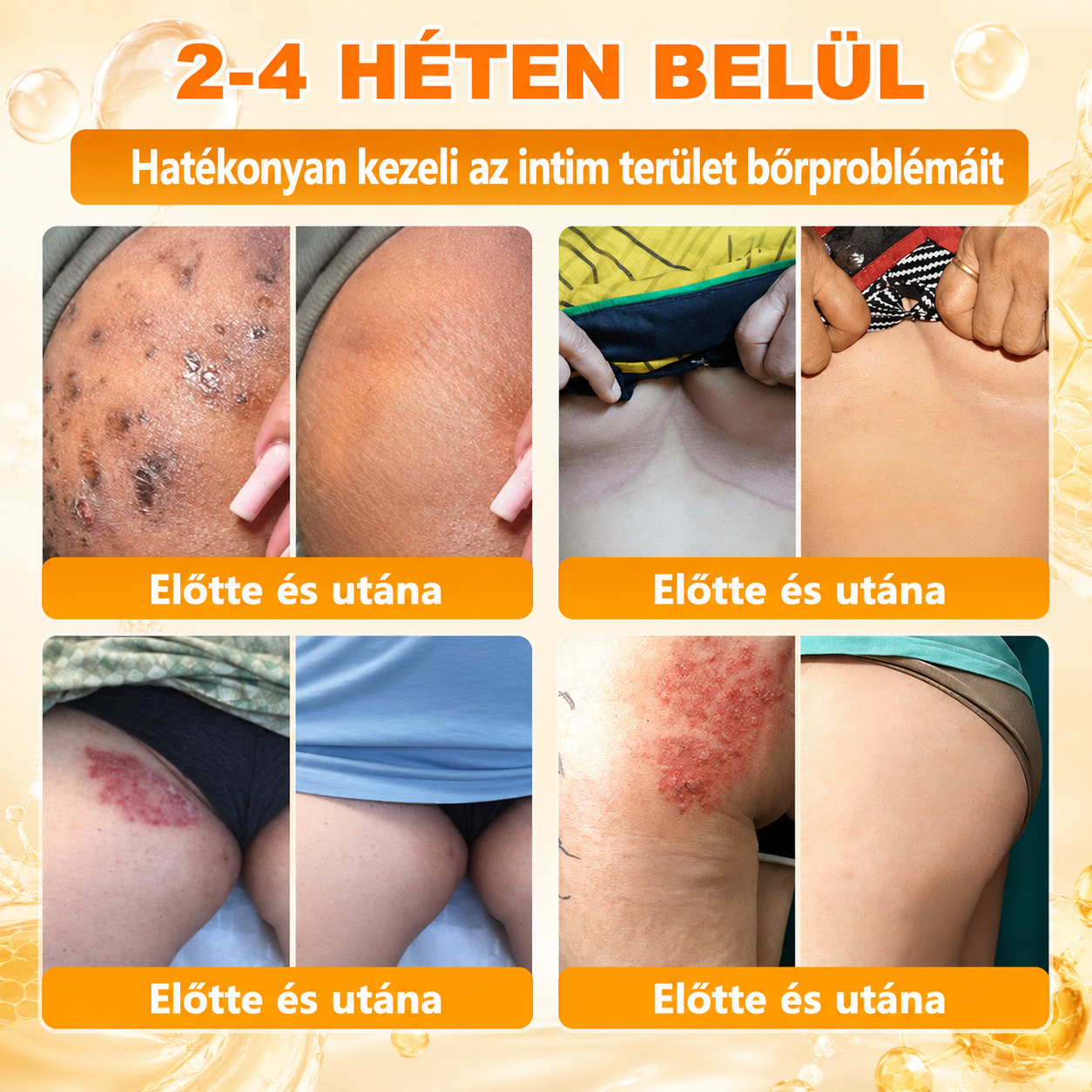 🥇Most 50% kedvezménnyel elérhető! ✨✨ DR.Fachmer® 🐝 Méhméreges Bőrmegújító Krém – Ráncok, Hegek, Pigmentfoltok, Striák, Akné, Ekcéma, Pikkelysömör Ellen (Copy) (Copy)